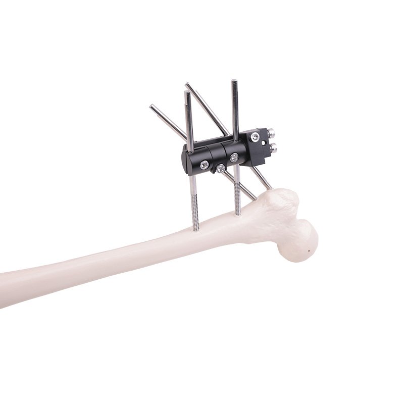 Transarticular external fixation series