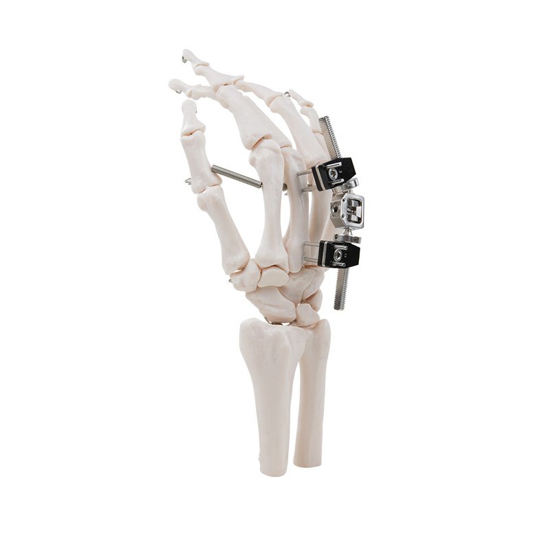 Mini External Fixation Series