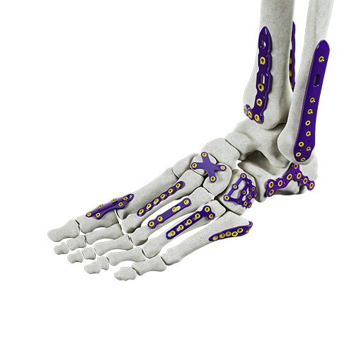 6-Foot & Ankle orthopedic System