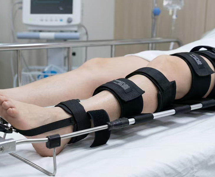 Purpose Built for Femur Fracture solutions